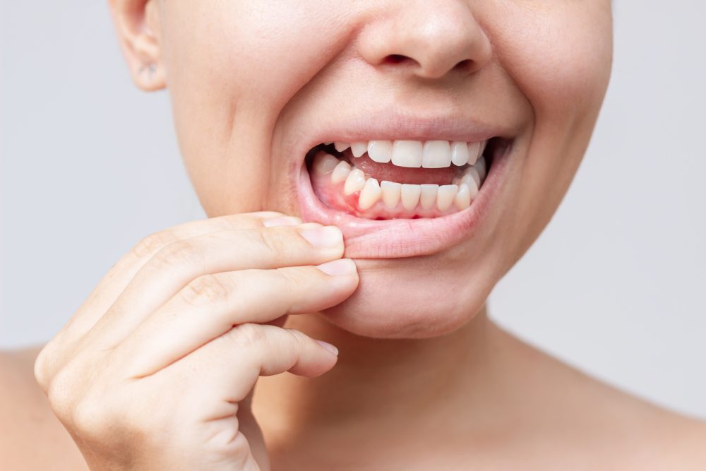 Gum Health